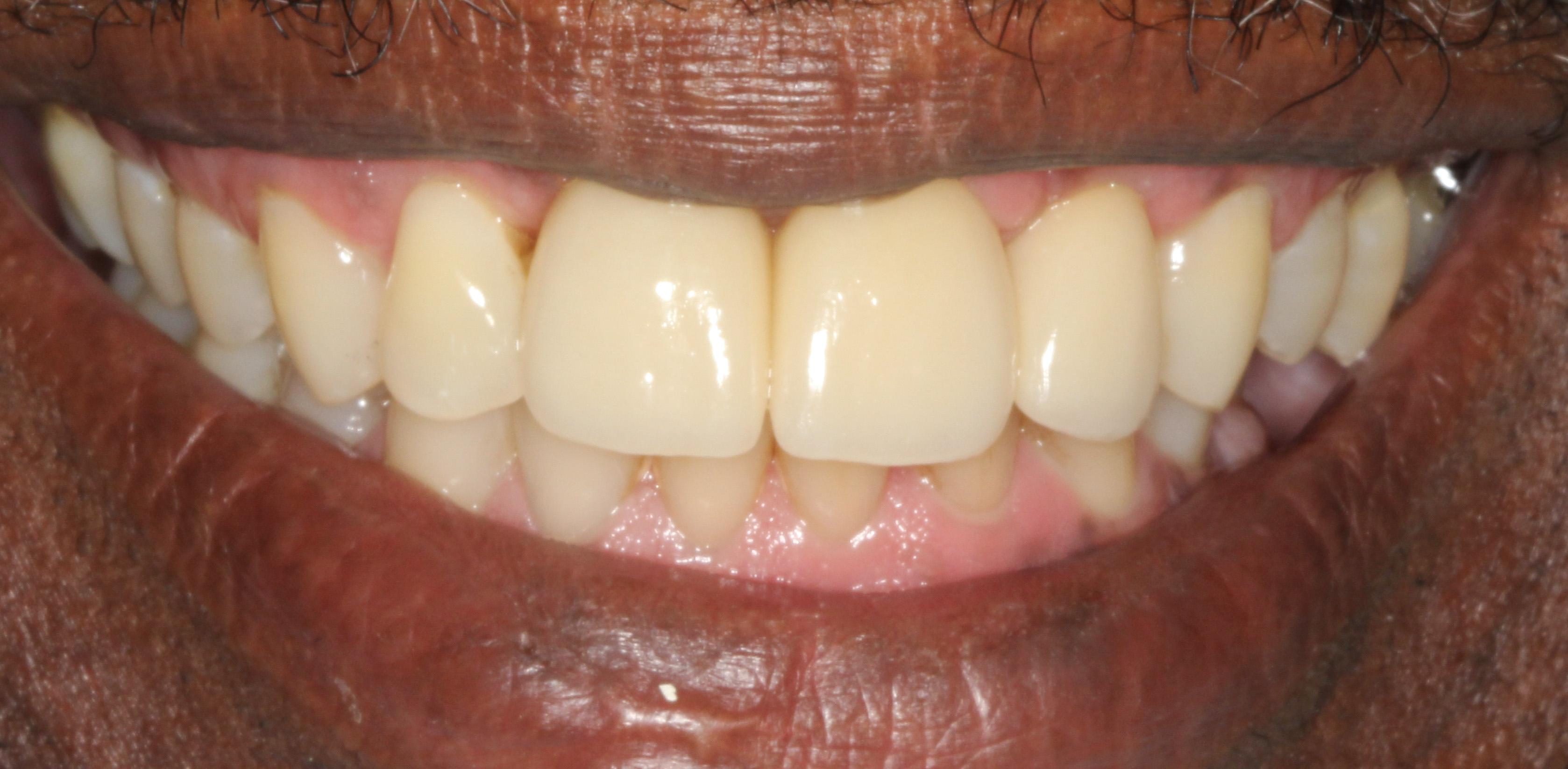 Implant crowns