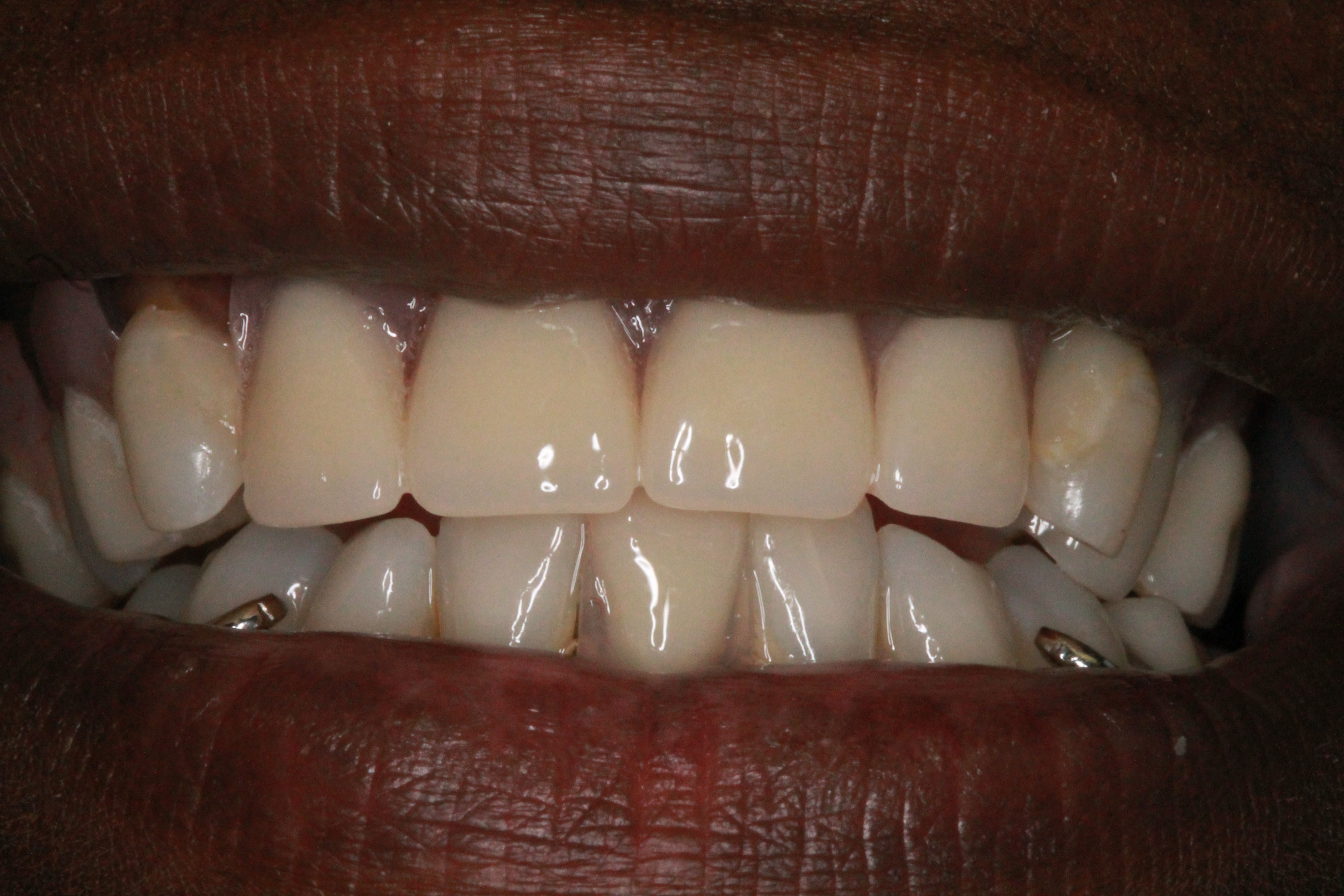 Partial Denture Case Completed