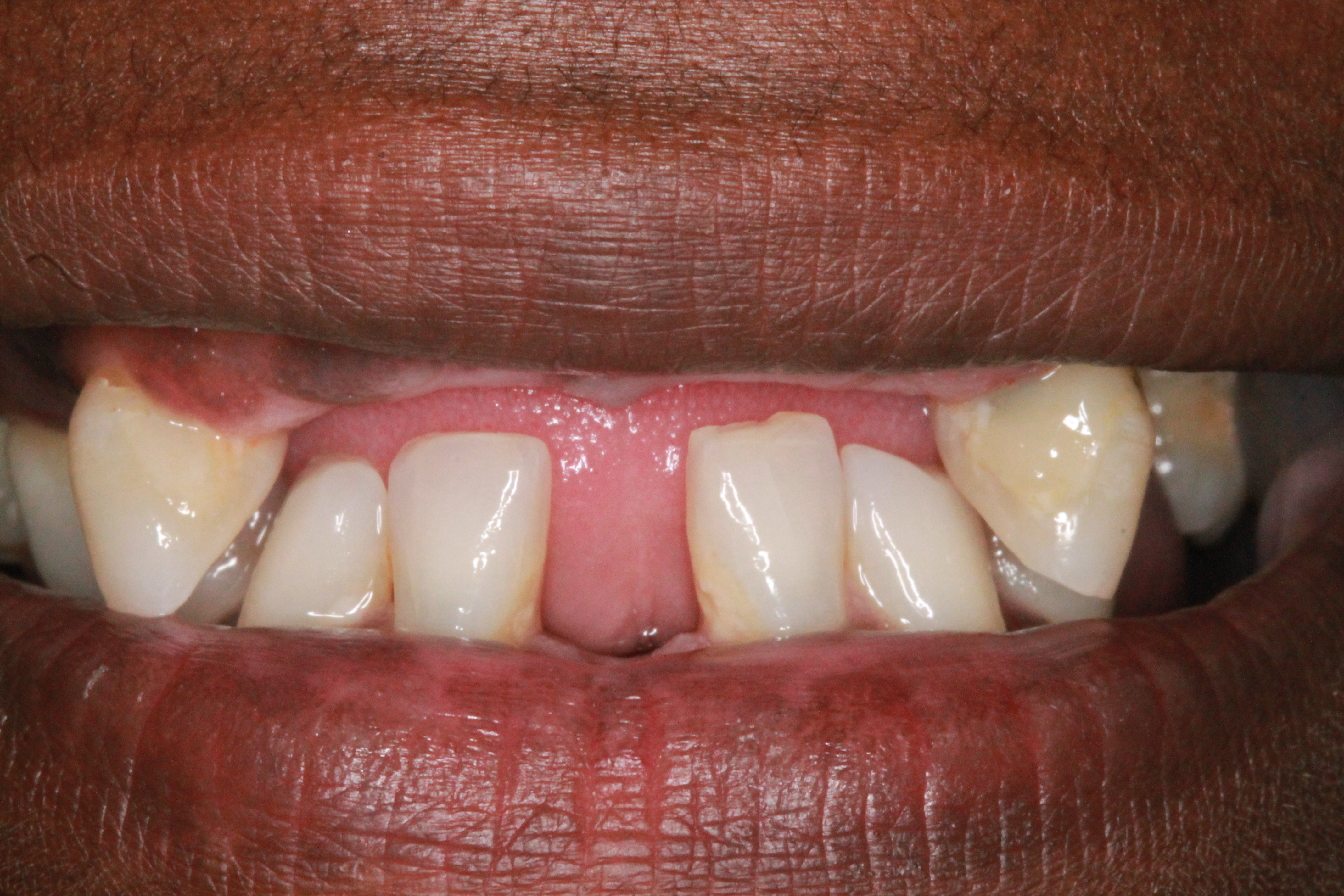 partial denture