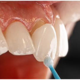 Patient displaying cosmetic porcelain veneers smile enhancement
